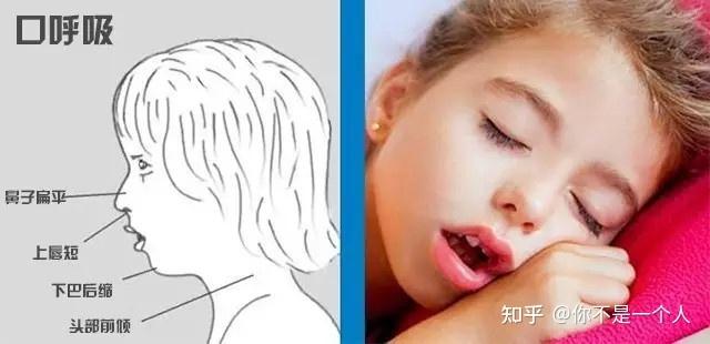孩子张嘴睡觉怎么纠正