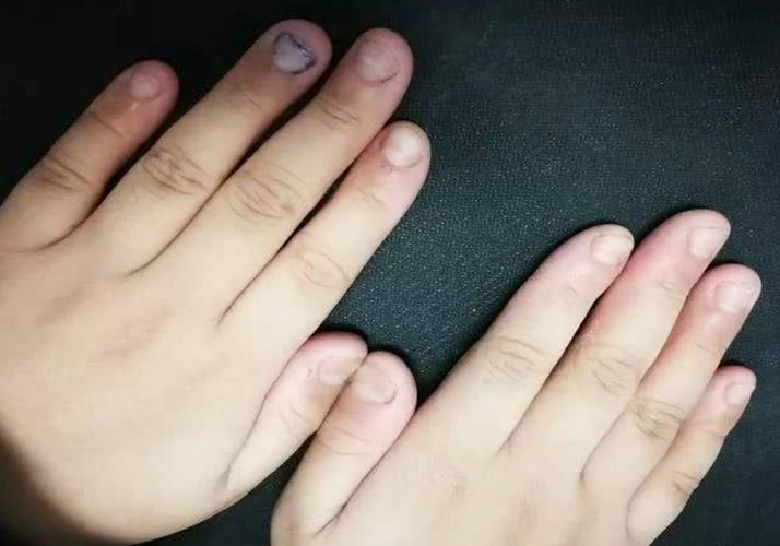 怎么防止孩子咬指甲