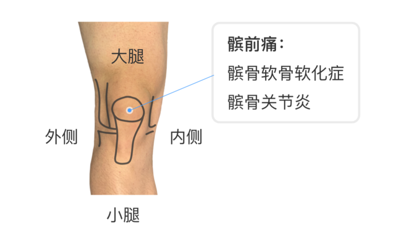 治疗剧烈运动后膝盖疼