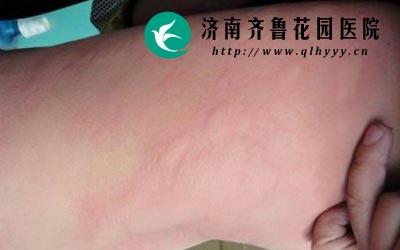 孩子荨麻疹反反复复怎么办
