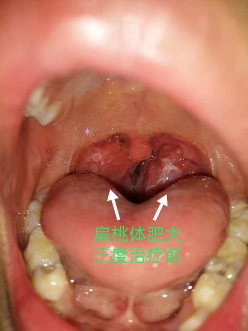 孩子扁桃体肥大怎么办