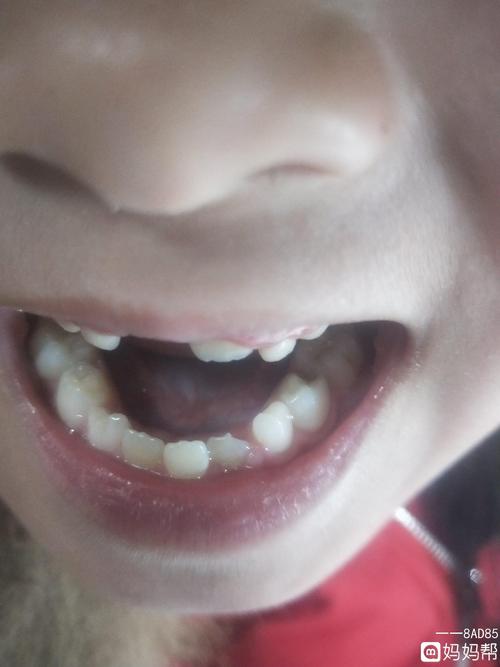 孩子牙齿长歪了怎么办