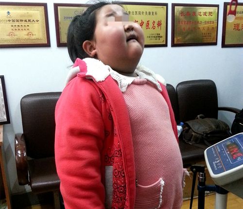 孩子太胖怎么办
