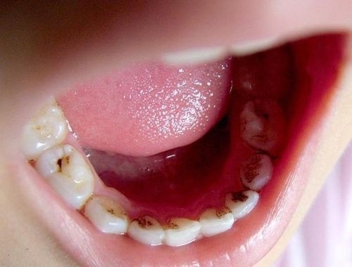 5岁孩子蛀牙疼怎么办