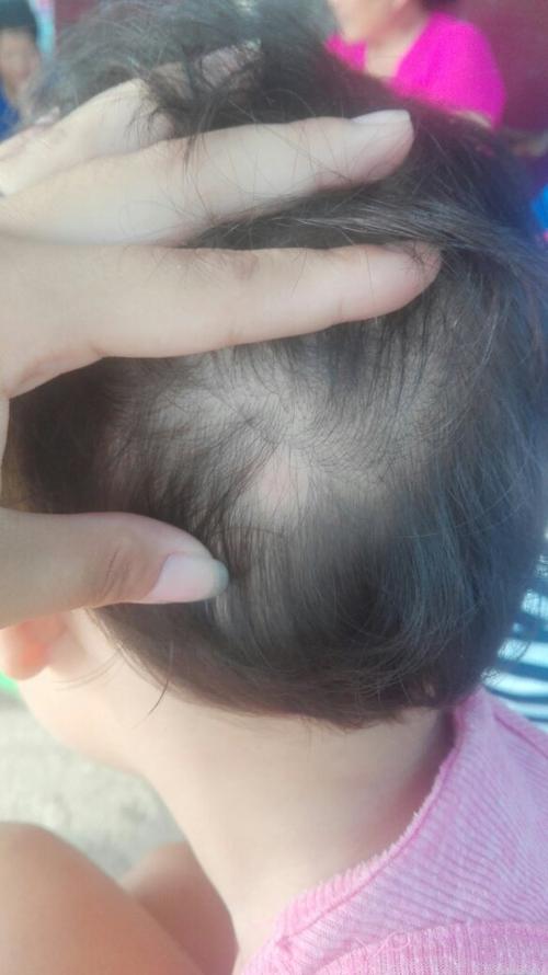小孩子怎么会掉头发
