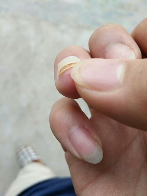 指甲扎进东西怎么办