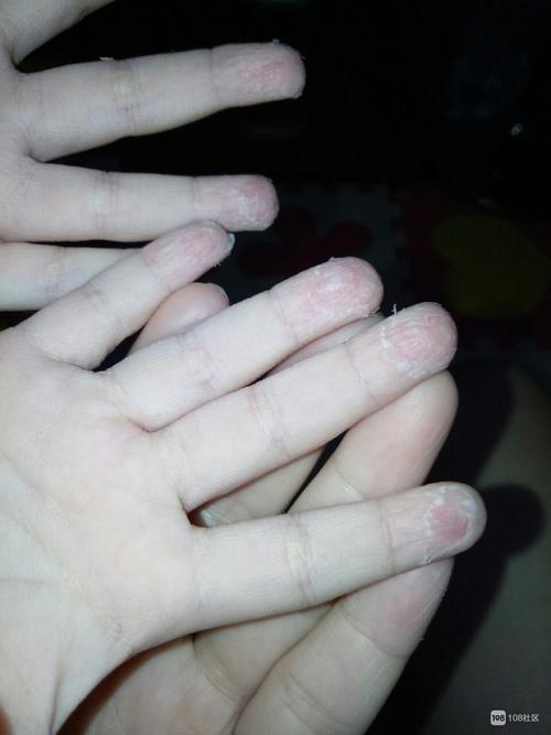 孩子手指头脱皮是怎么回事