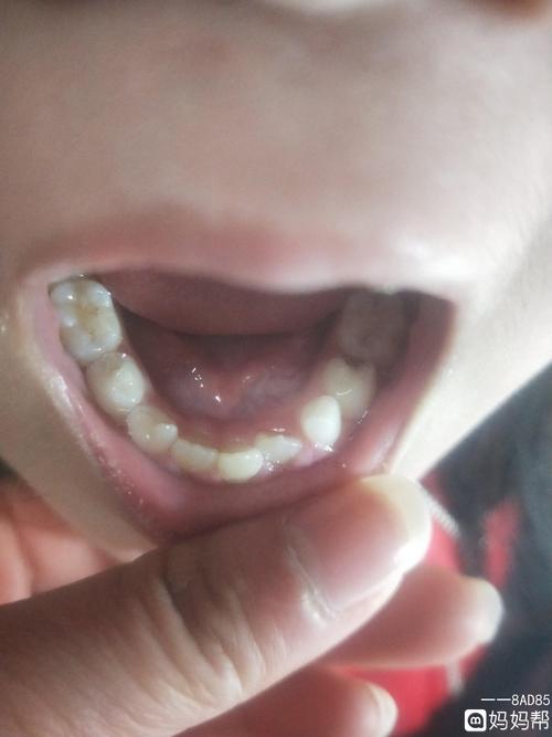 小孩子新牙长歪了怎么办