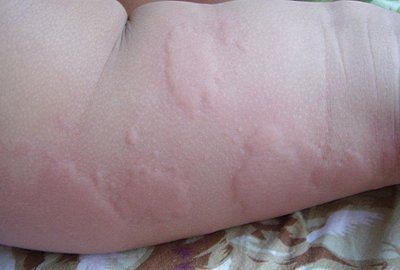 孩子荨麻疹怎么治疗