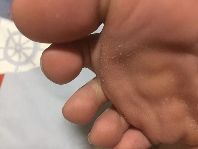 十岁孩子脚臭怎么办