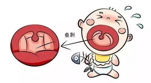 嗓子眼里卡东西了怎么办