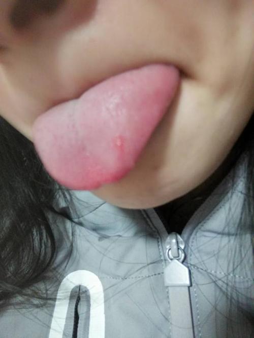 孩子舌头起泡怎么回事