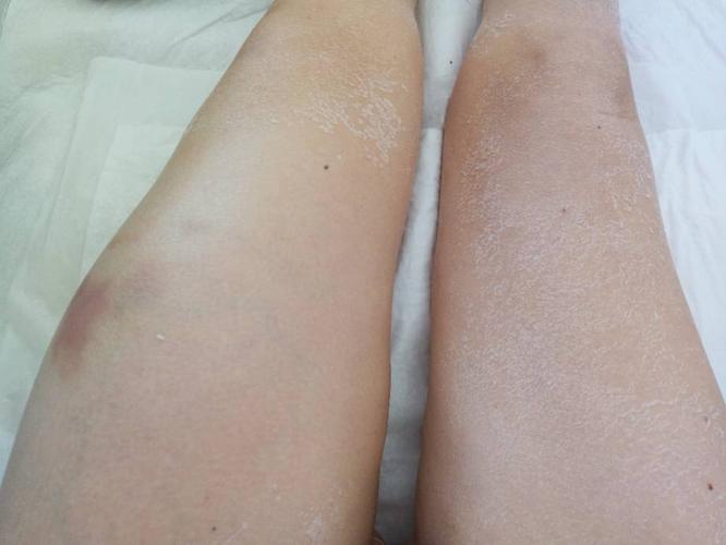 运动大腿肿了怎么按摩