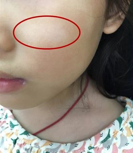 孩子脸上有白斑怎么办
