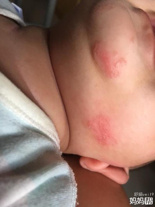 孩子身上起湿疹怎么办