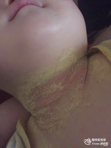 孩子腋下淹了怎么办
