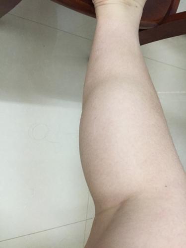 缺少运动小腿肿胀