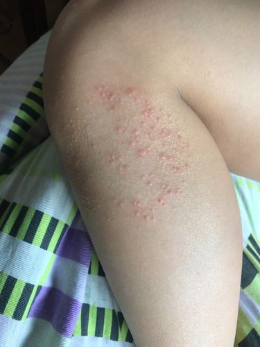 孩子身上起疹子怎么办