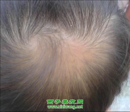 小孩子脱发怎么办