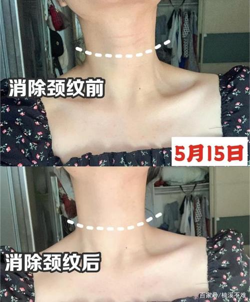 去颈纹最有效的运动