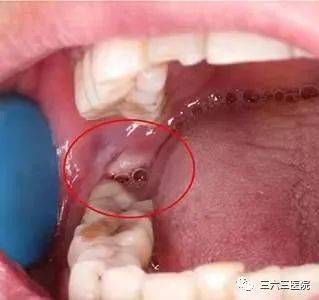 小孩子长智齿怎么办
