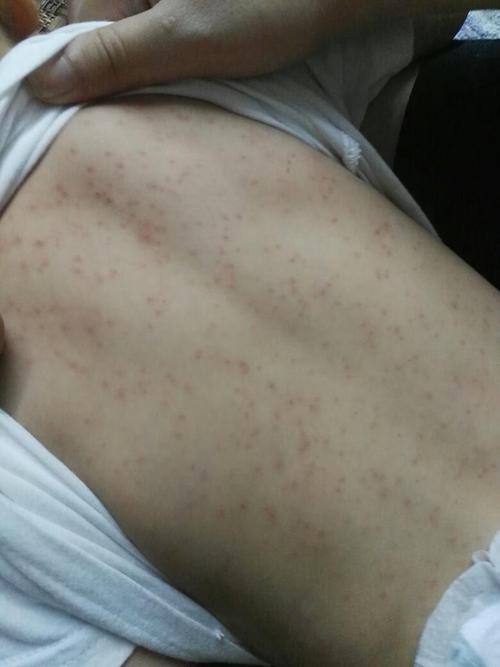 孩子身上起风疹怎么办