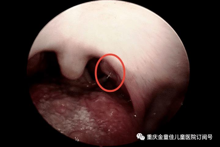 喉咙感觉有东西卡住