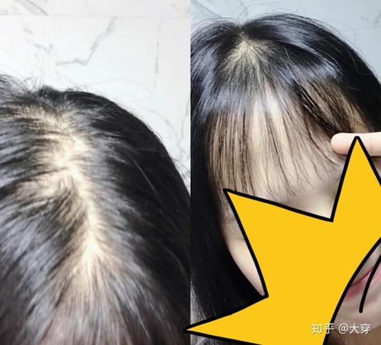 女孩子掉发严重怎么办