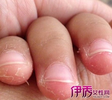 孩子手脚脱皮怎么办