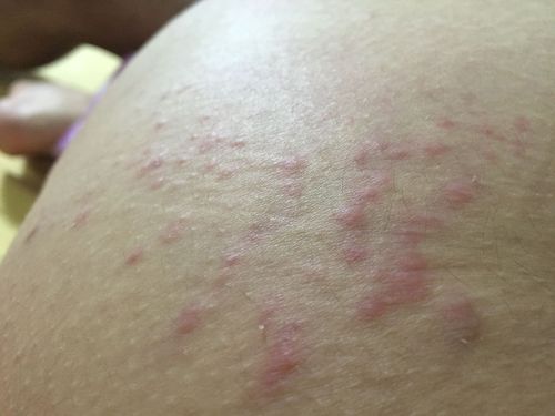 生完孩子肚子痒怎么办