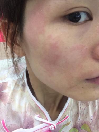 孩子脸过敏了怎么办