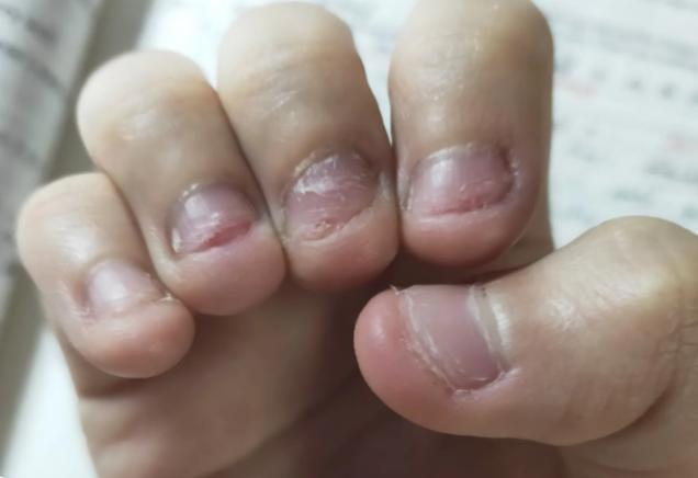 小孩子咬手指甲是怎么回事