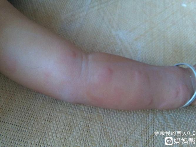 孩子起风团怎么办