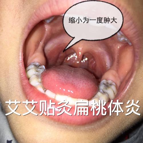 小孩子扁桃体肿大怎么办