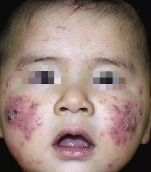 孩子长青春痘怎么办