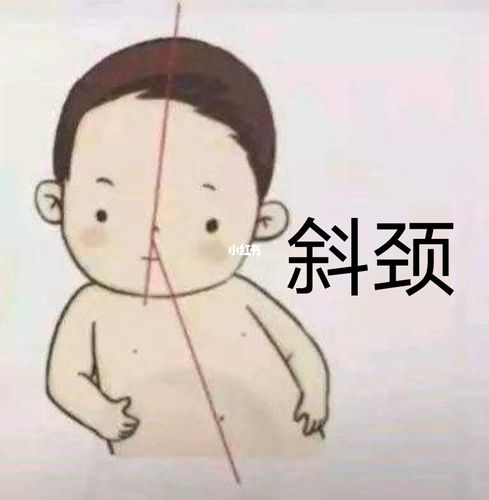 怎么判断孩子是不是斜颈
