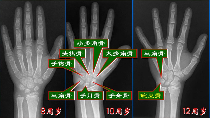 孩子怎么测骨龄