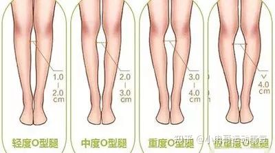 小孩子罗圈腿怎么矫正