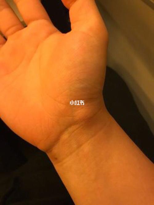 抱孩子手腕疼怎么缓解
