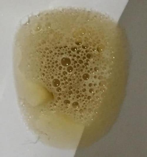 孩子尿有泡沫怎么回事