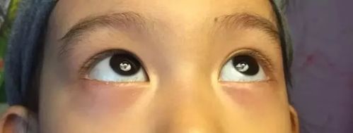孩子有眼袋怎么办