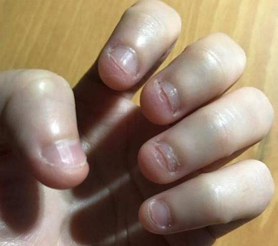 孩子吃指甲怎么办