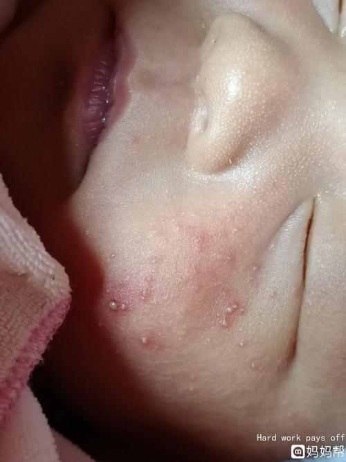 孩子满脸痘痘怎么办