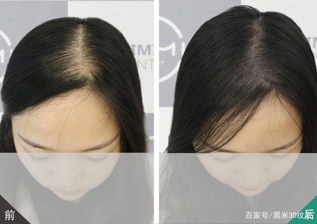 女孩子脱发严重怎么办