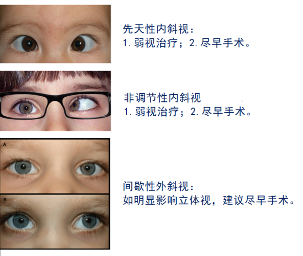 孩子斜视怎么办