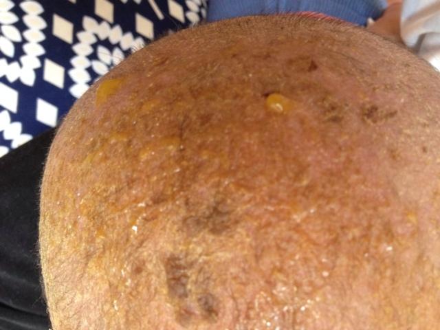 孩子头上湿疹怎么办