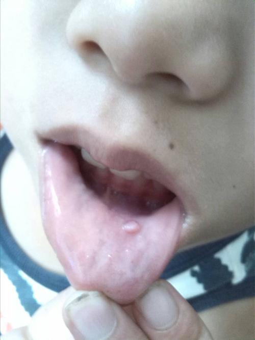 嘴角长了一个小肉块的东西