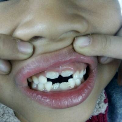 孩子门牙大怎么办