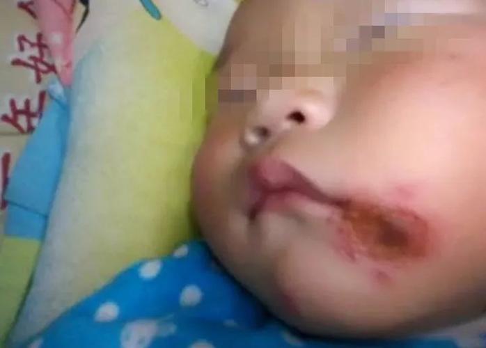 小孩子烂嘴角怎么回事