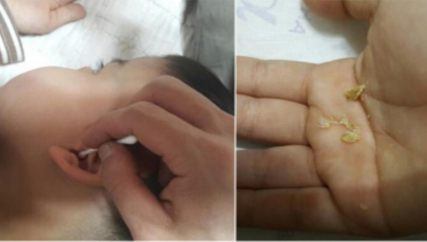 小孩子耳屎很多怎么办